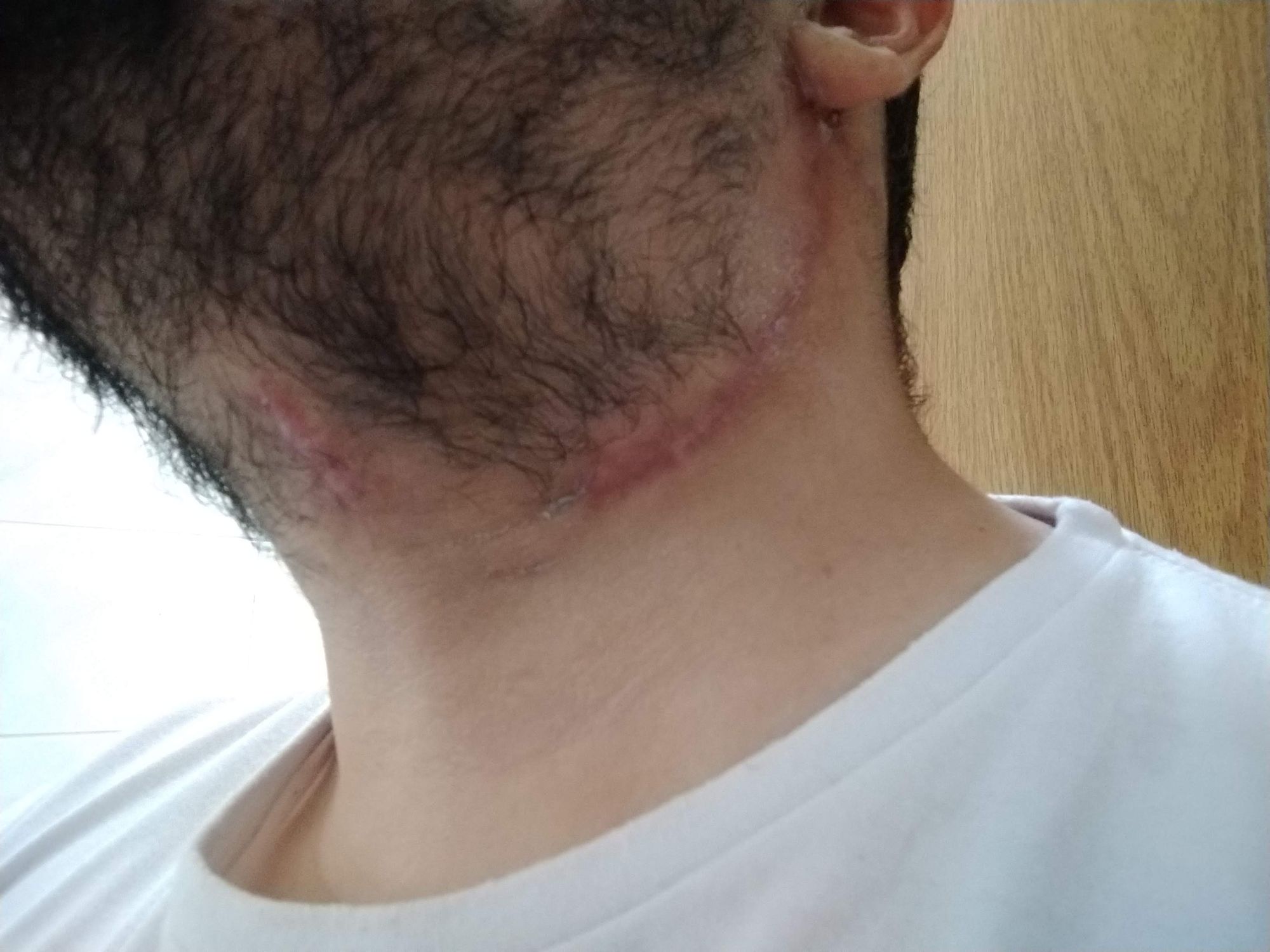 Cirurgia Plástica - expansor de tecido