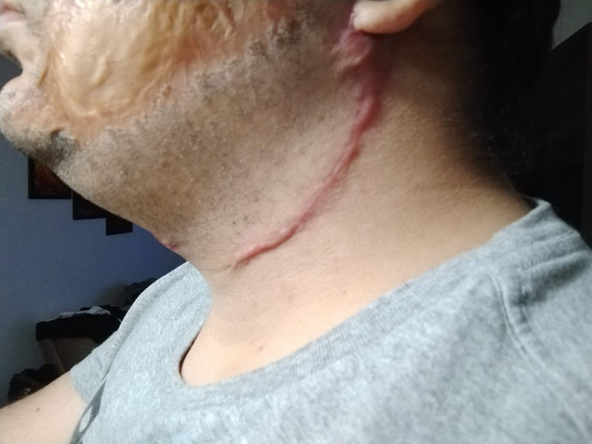 Cirurgia Plástica - expansor de tecido