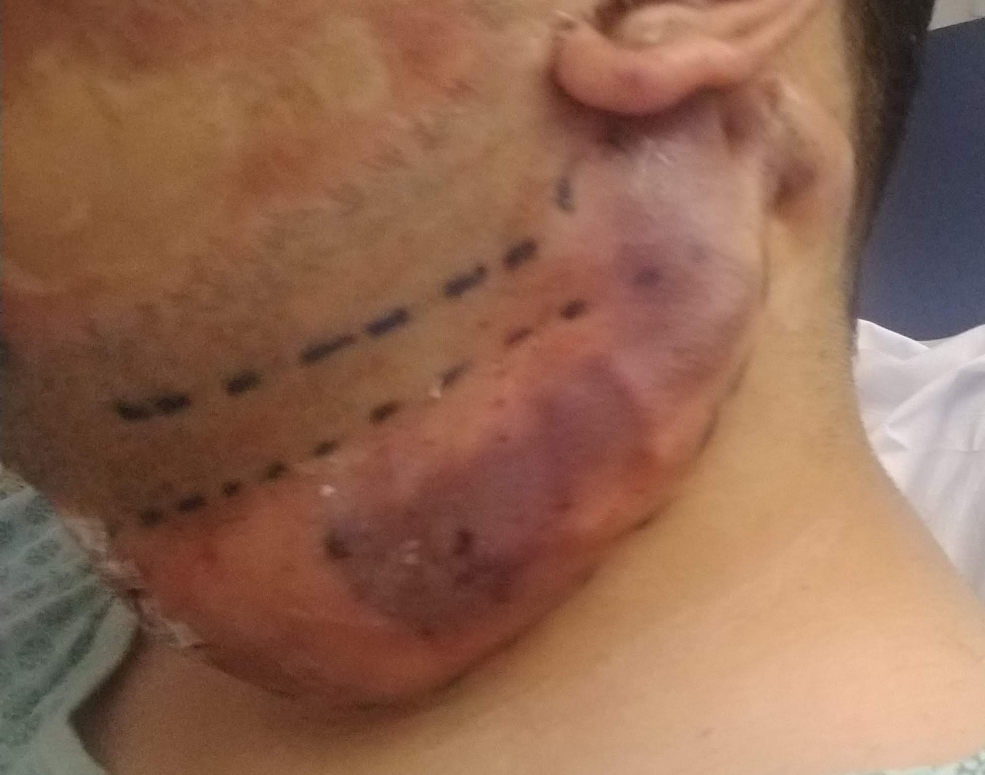 Cirurgia Plástica - expansor de tecido