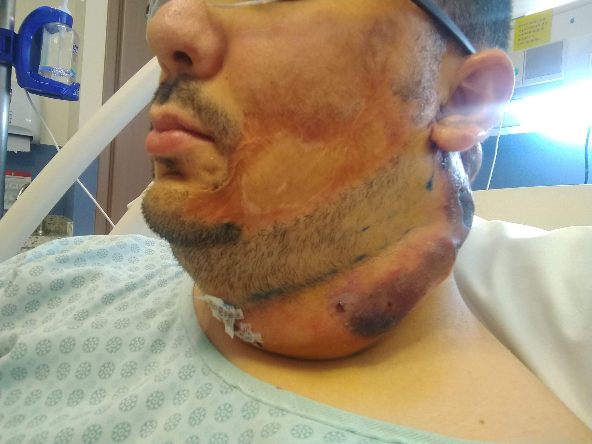 Cirurgia Plástica - expansor de tecido